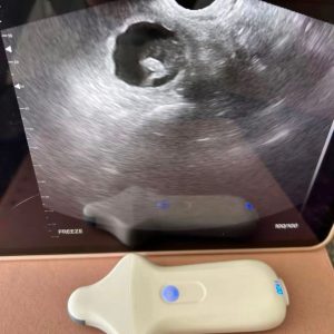 Hand-Held Ultrasound Scanners